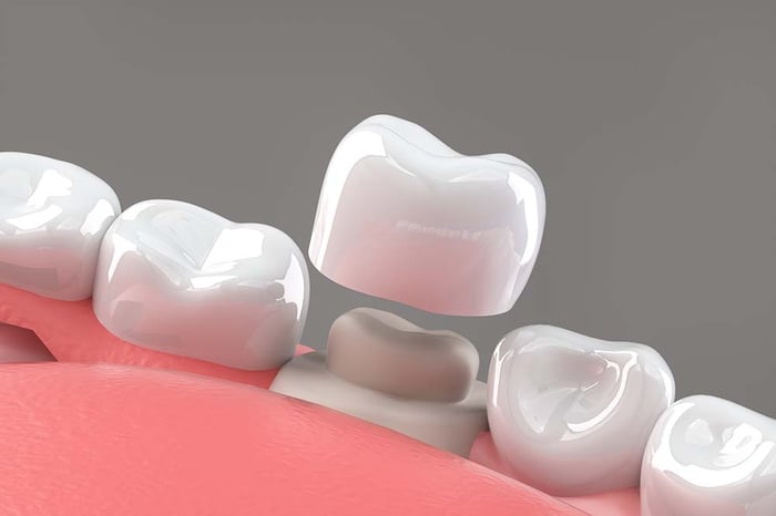 04_dental crown placement