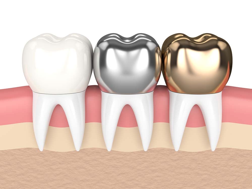 Veneers vs Crowns Knowing the Pros and Cons