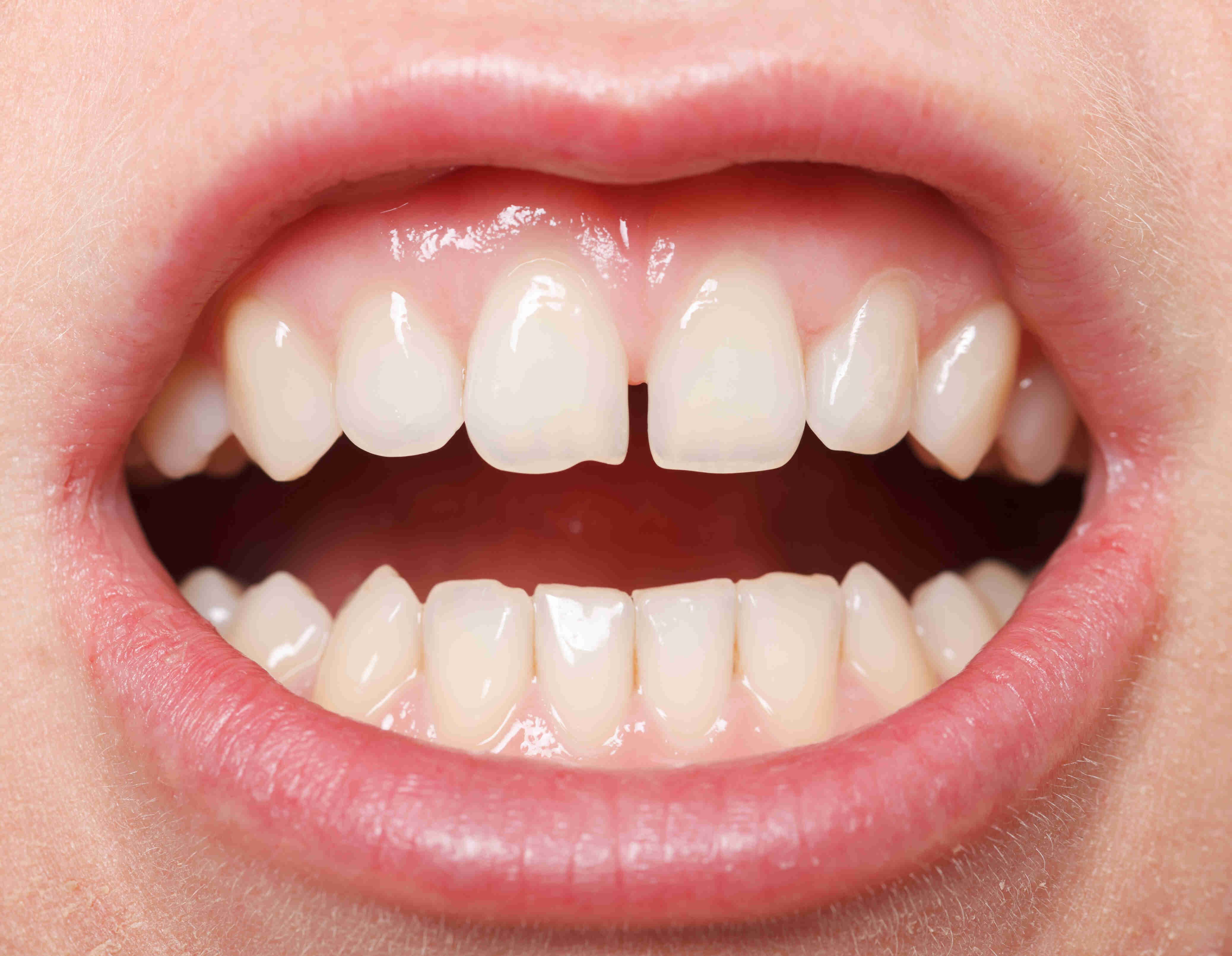 10_Gaps between teeth