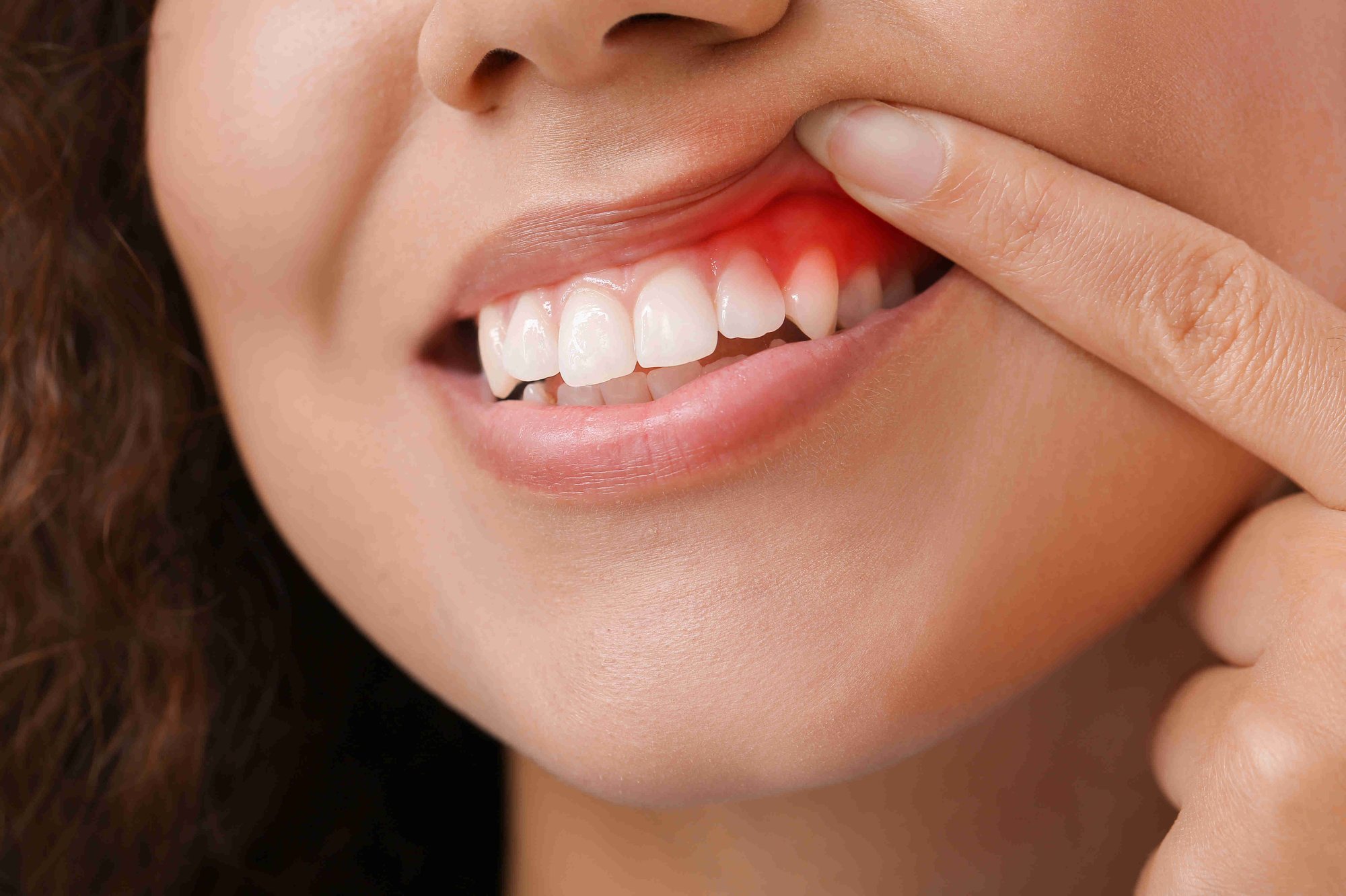 25_Gum disease