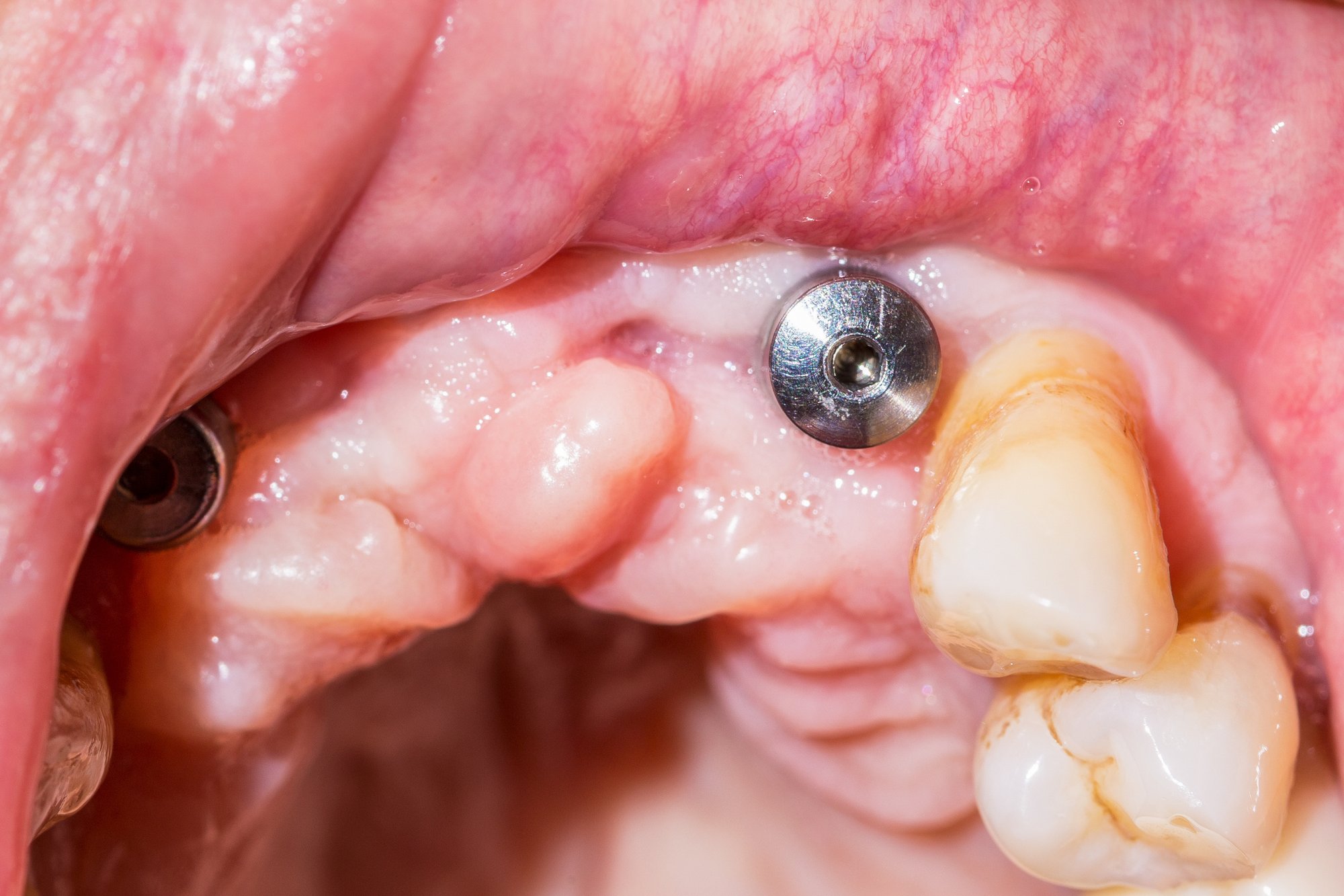A macro shot of dental implant in the mouth of a patient with advanced periodontitis