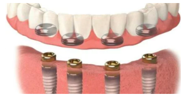 Copy-of-Dental-Implant-Cost-Singapore-Explore-the-Subsidies-Available-Google-Docs-03-17-2025_06_54_PM