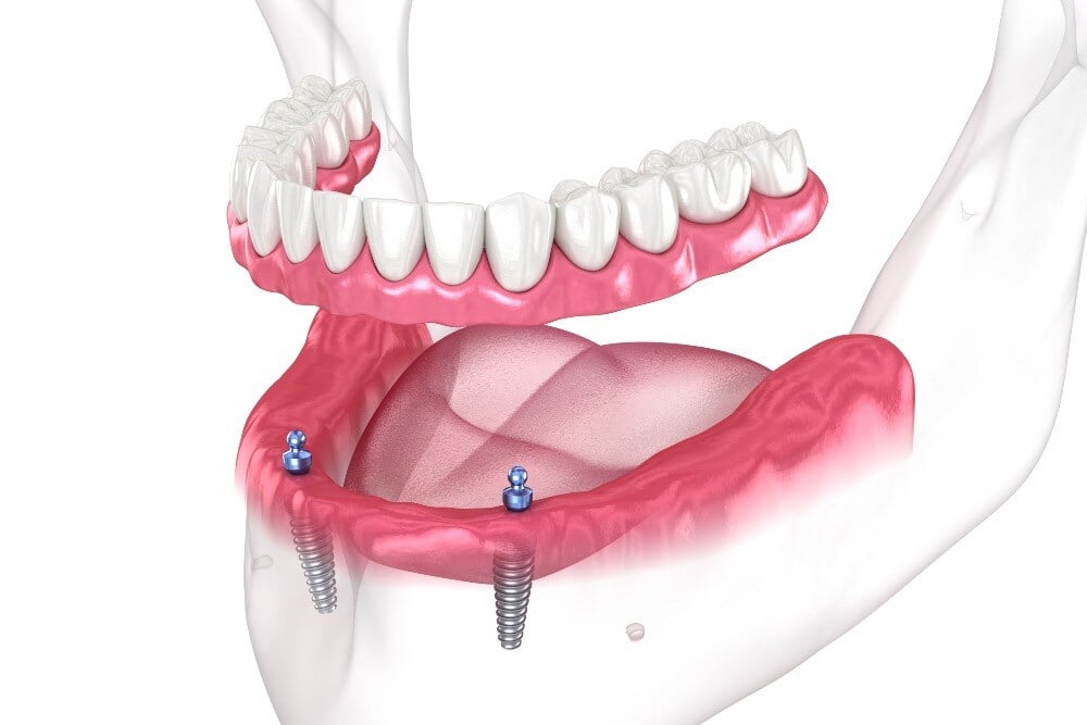 Dental Implant Overdenture 