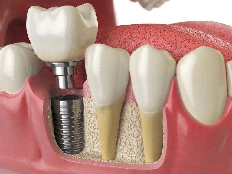 Dental implant model illustrating tooth replacement options