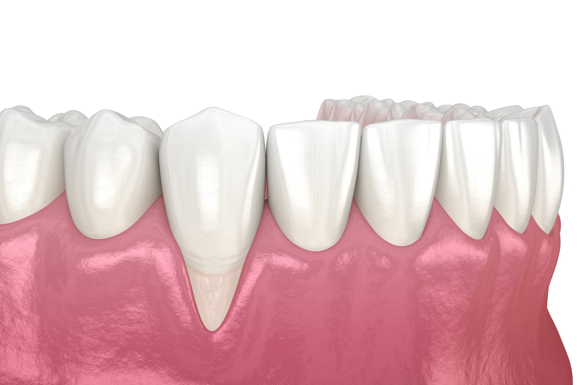 Gum Recession. 3D illustration of Dental problem