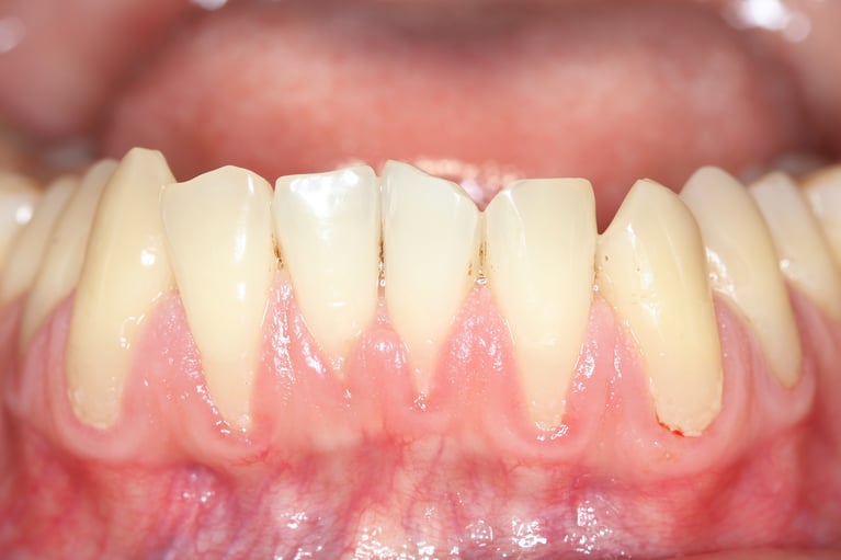 Receding Gums in Singapore Causes, Treatment & Cost