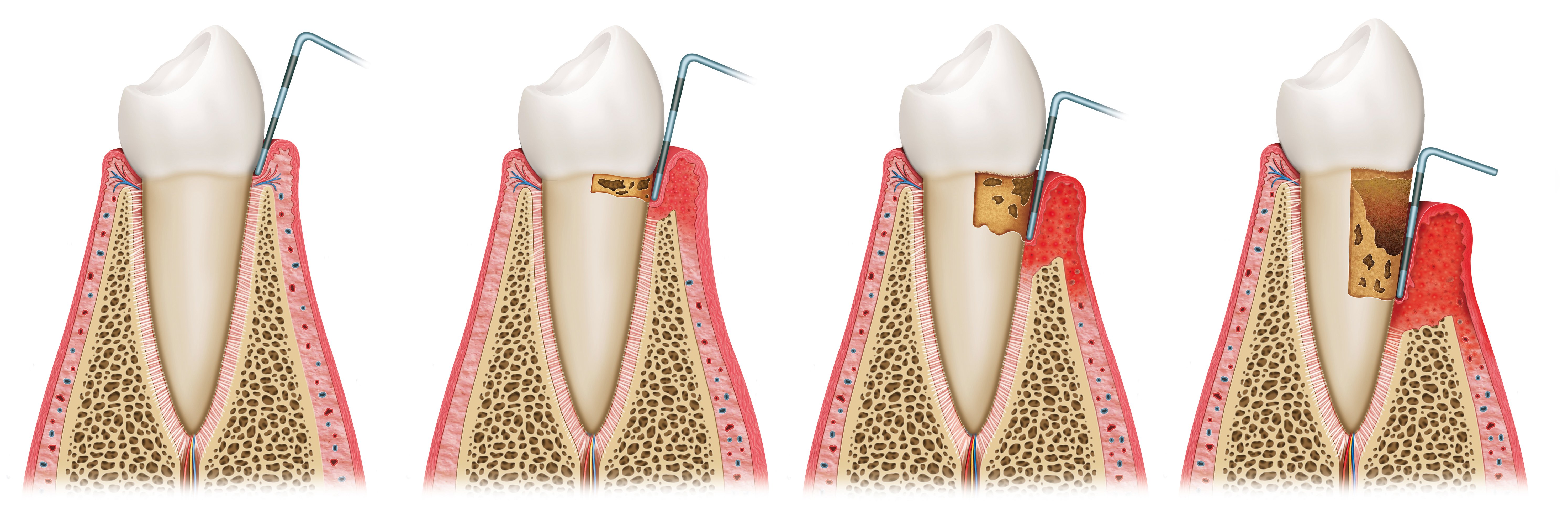 02_mild to severe gum disease. gingivitis to periodontitis