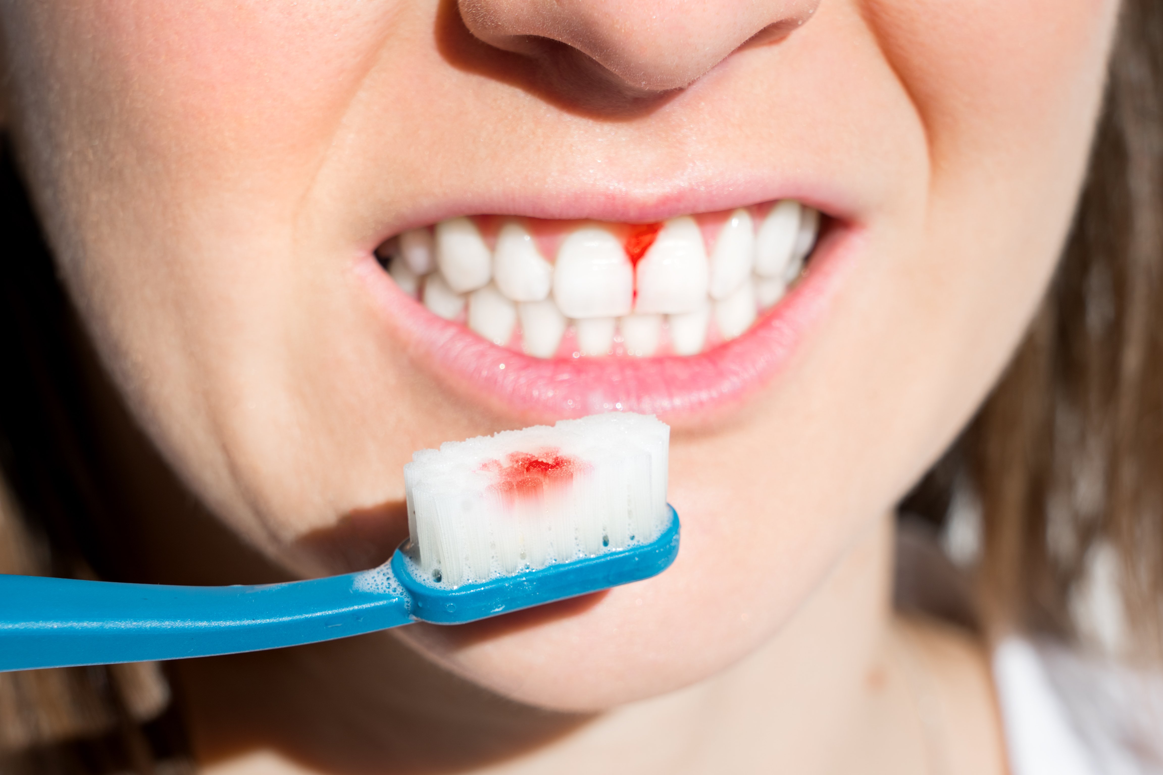 03_bleeding gums