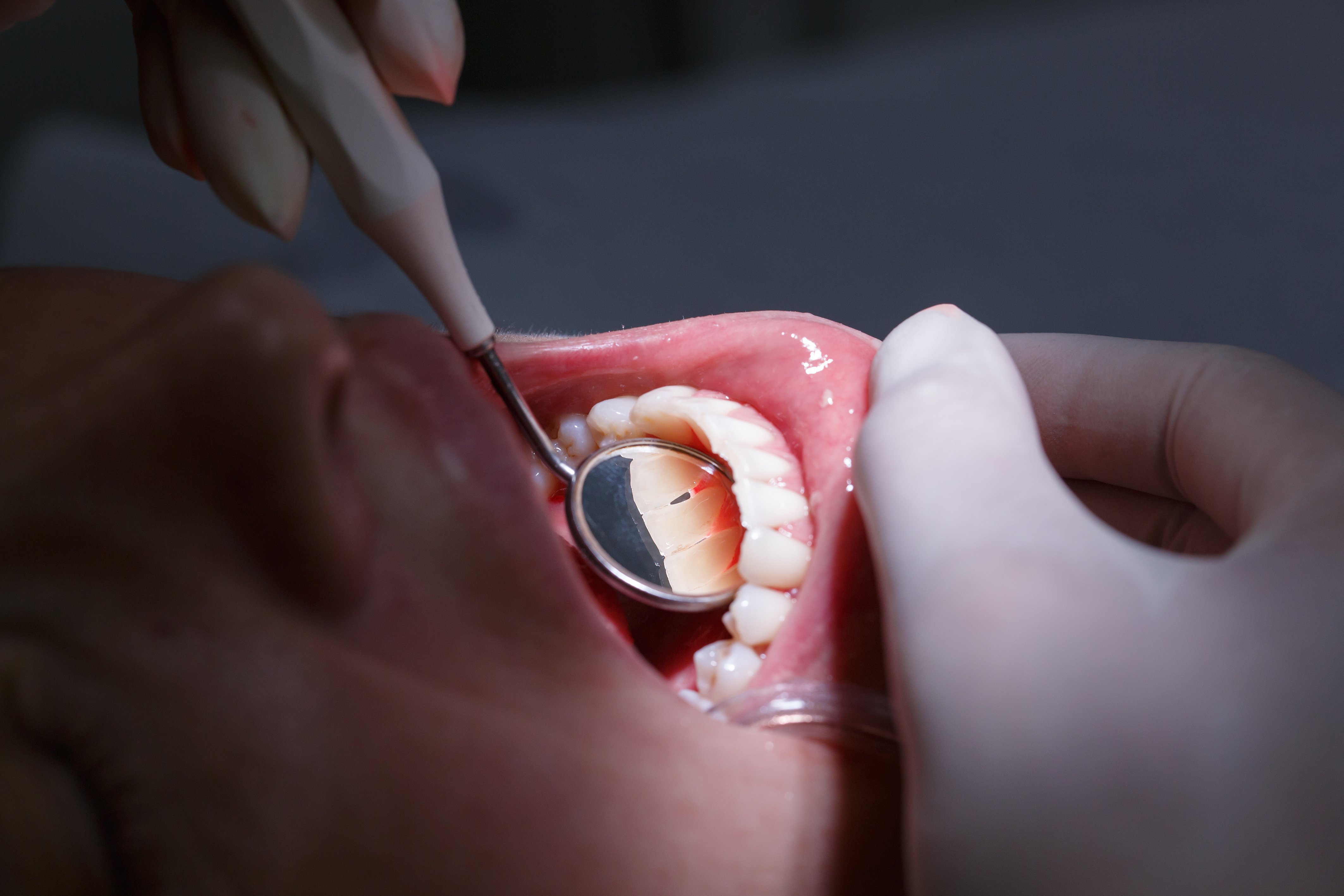 04_dental check for receding gums