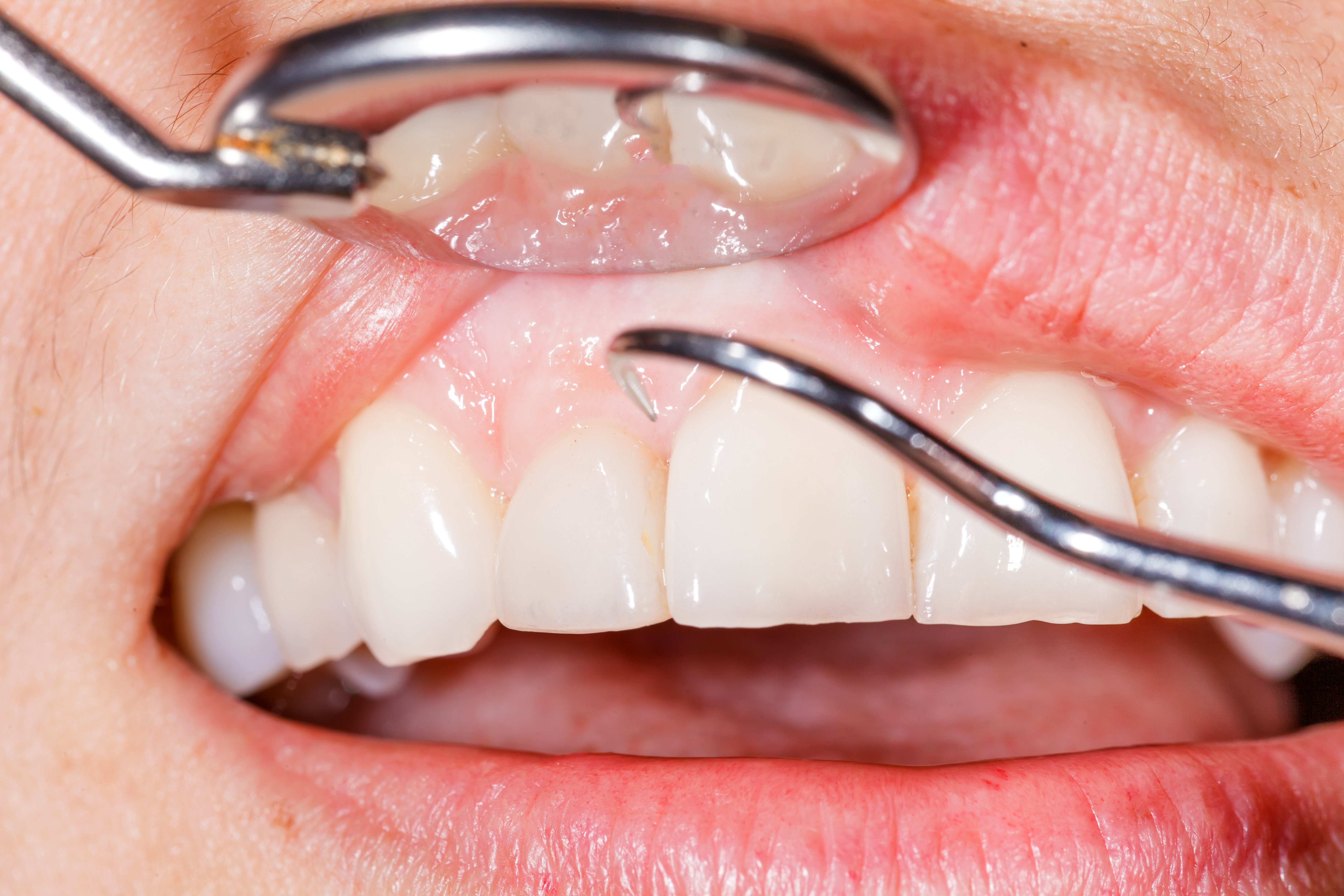 05_dental check for receding gums (2)