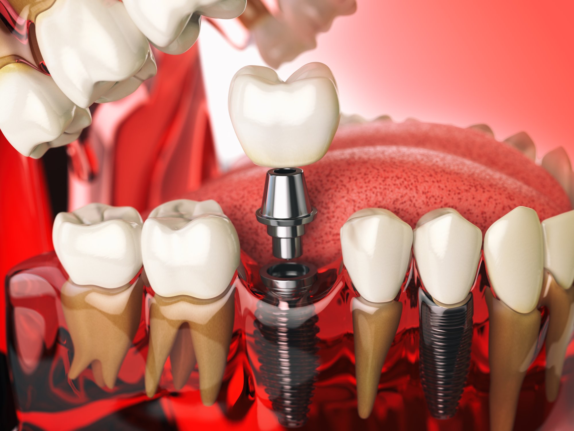 Dental-Implants-Singapore-Image