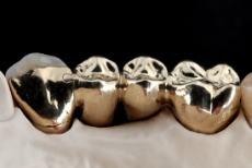 Metal Crowns
