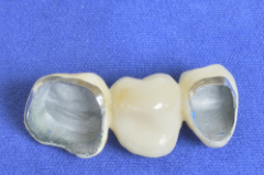 Porcelain-fused-to-metal (PFM) Crowns