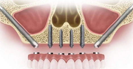Pterygoid Dental Implants