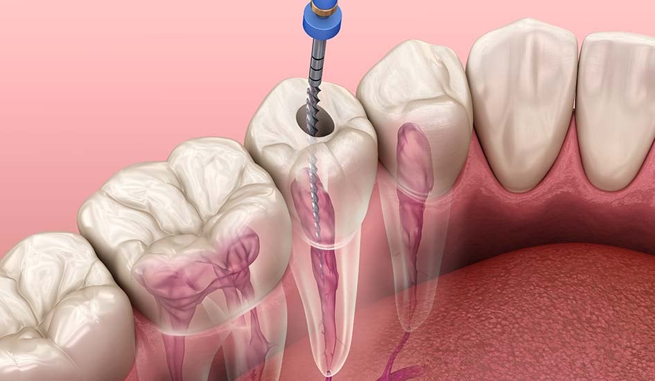 Root Canal Treatment-1
