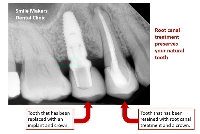 Root-Canal-Treated-Tooth-and-Implant