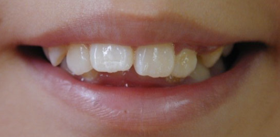 childs-teeth