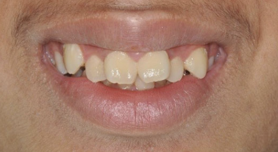 crowded-teeth