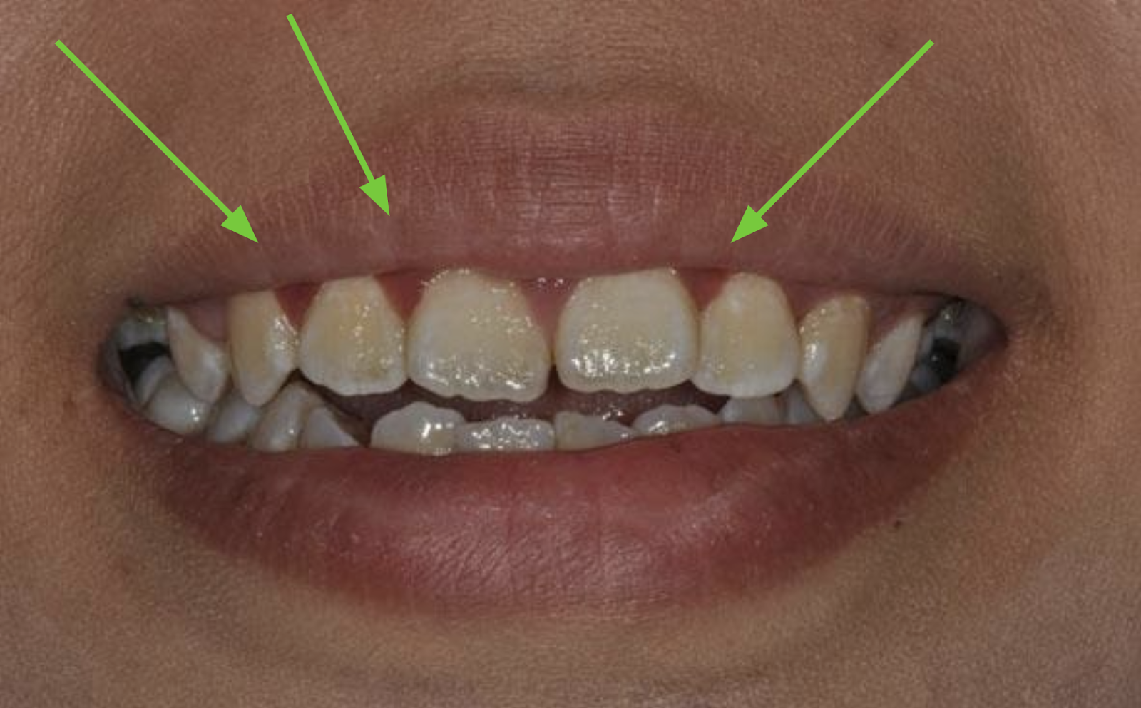 Tooth Red Signs of Gum Disease