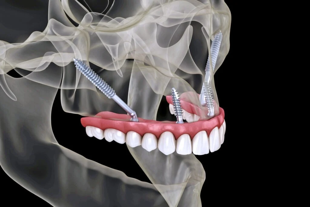 Zygomatic Implants