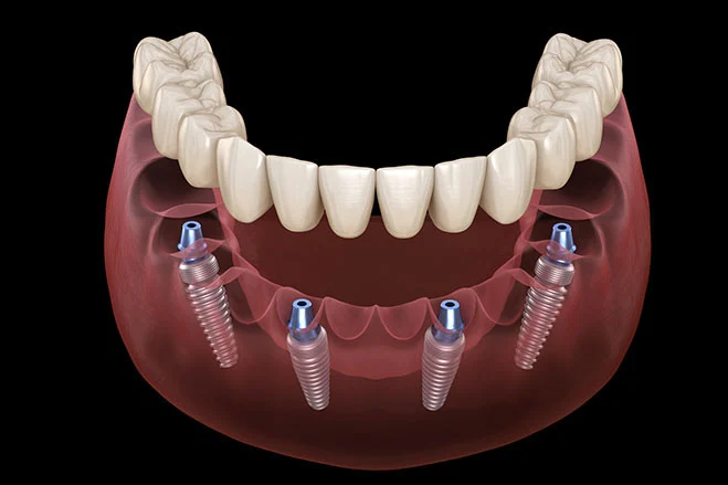 all on 4 implants