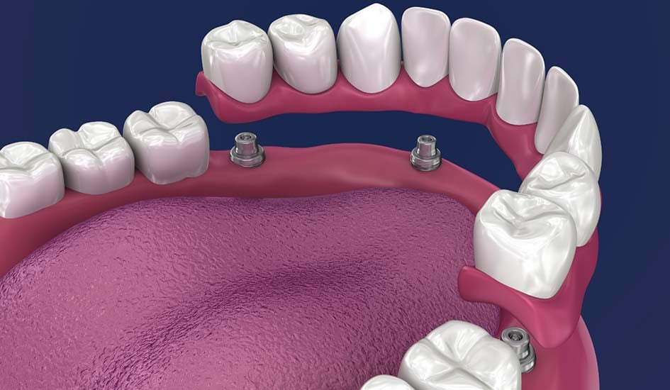 all-on-4-dental-implants-dental-care-oral-health