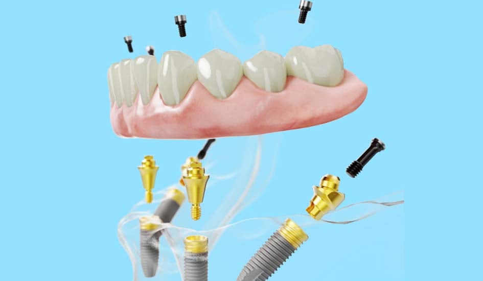 all-on-4-treatment-concept-by-nobel-biocare-dental-care-oral-health-blue-background