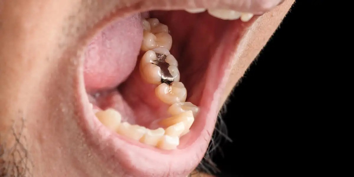 amalgam filling