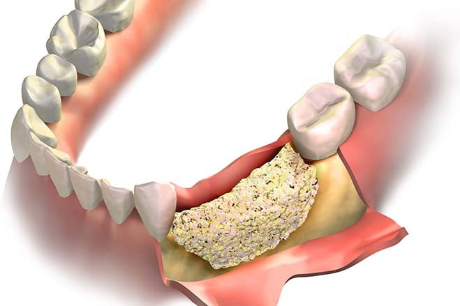 bone-grafting-dental-care-oral-health-check-up