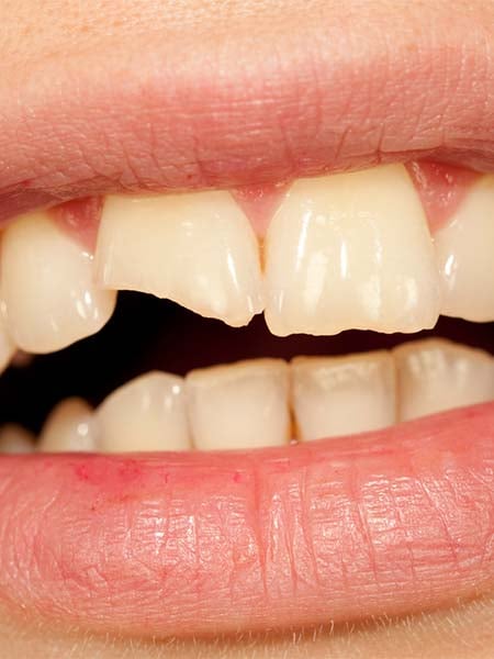 broken-tooth-dental-care