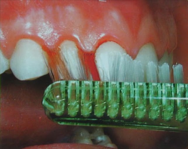 brushing gums 