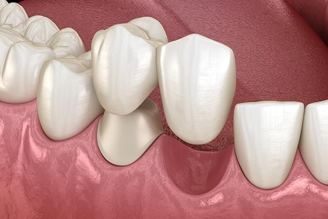 cantilever-bridges-smile-dental-care-oral-health