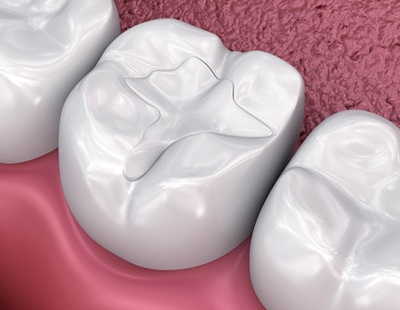 ceramic fillings
