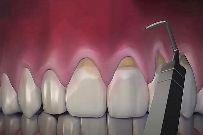chao-pinhole-gum-rejuvenation-oral-health-dental-care