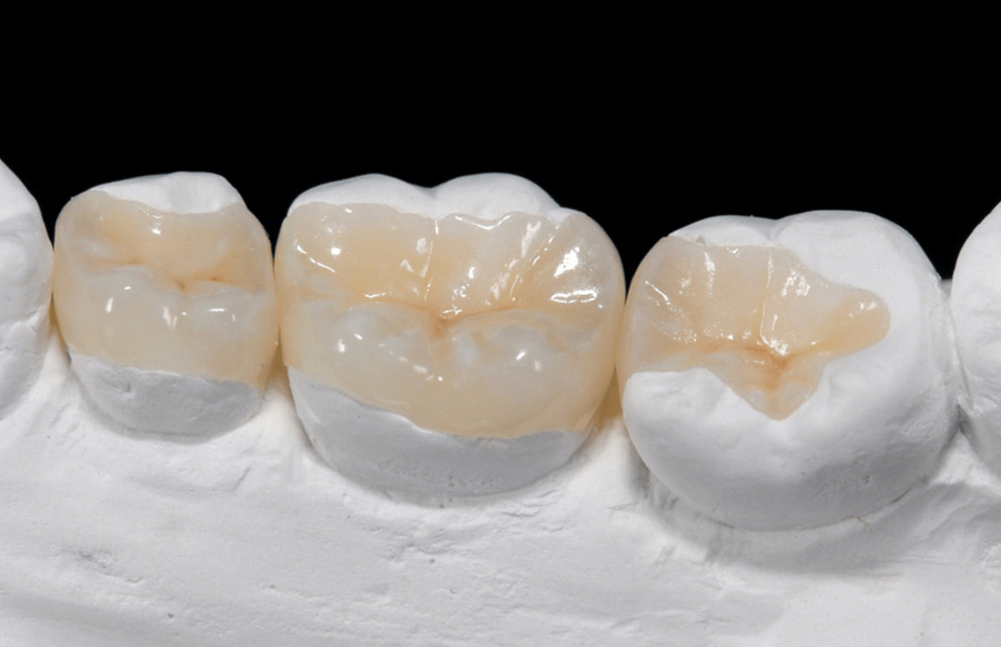 composite dental crown