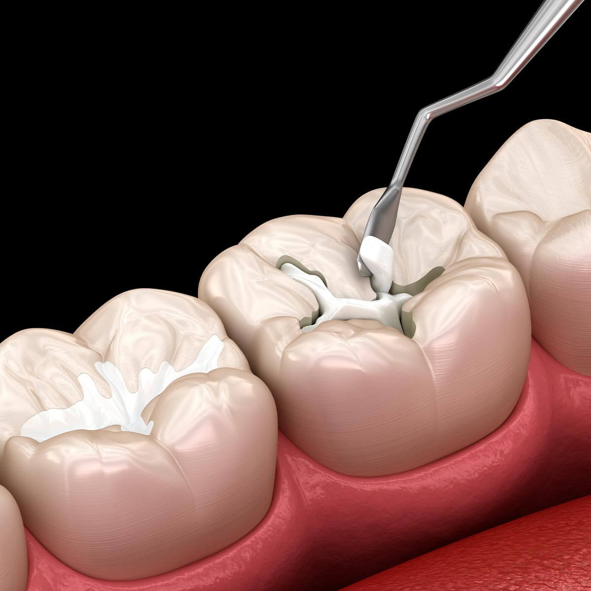 composite fillings