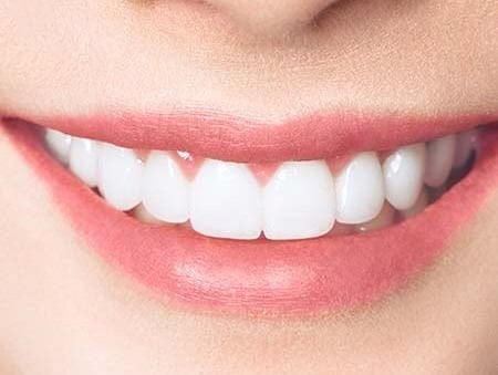 composite-bonding-smiling-girl-whitening-teeth-dental-care-oral-health-2
