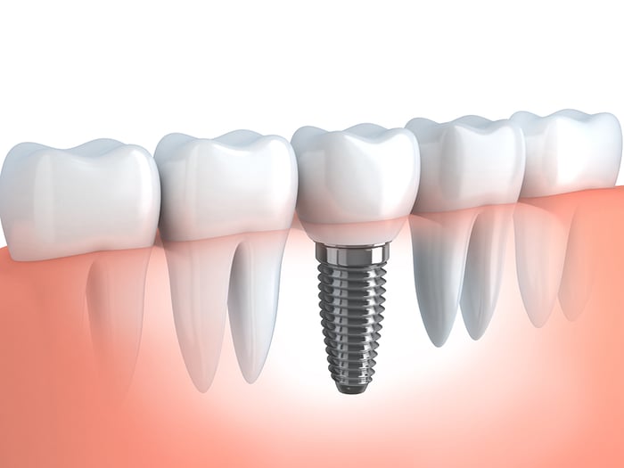 cosmetic dentistry dental implant replace missing teeth