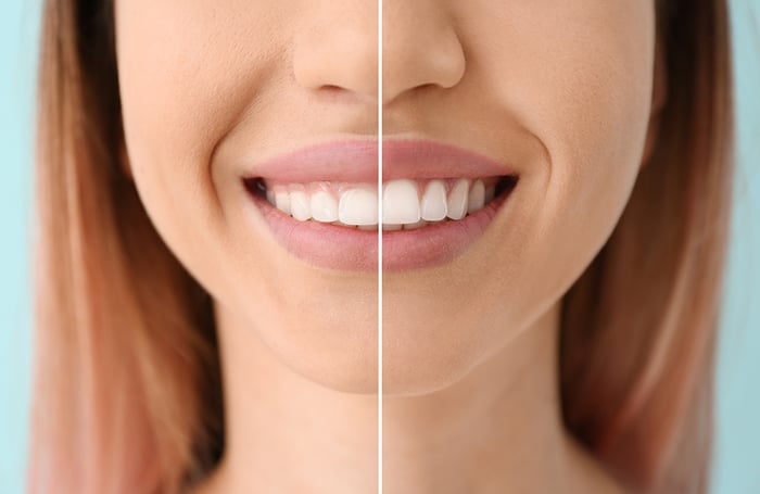 cosmetic dentistry gum contouring