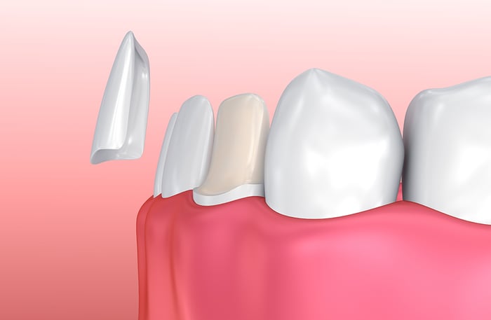 cosmetic dentistry veneers