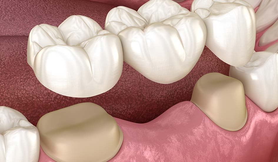 dental-bridges-dental-care-oral-health