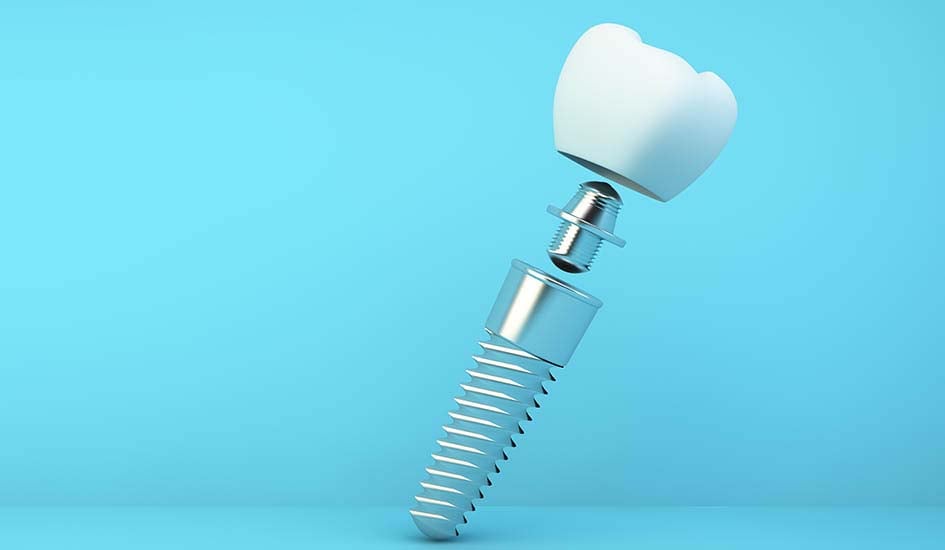 dental-implants-dental-care-oral-health