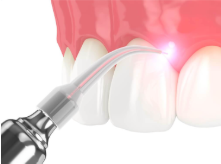 dental-lasers