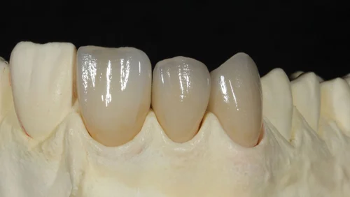 emax crown