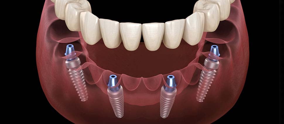 everything-you-should-know-about-all-on-4-dental-implants-dental-care-oral-health