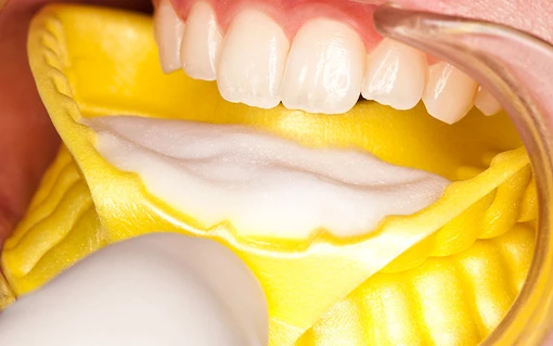 fluoride foam