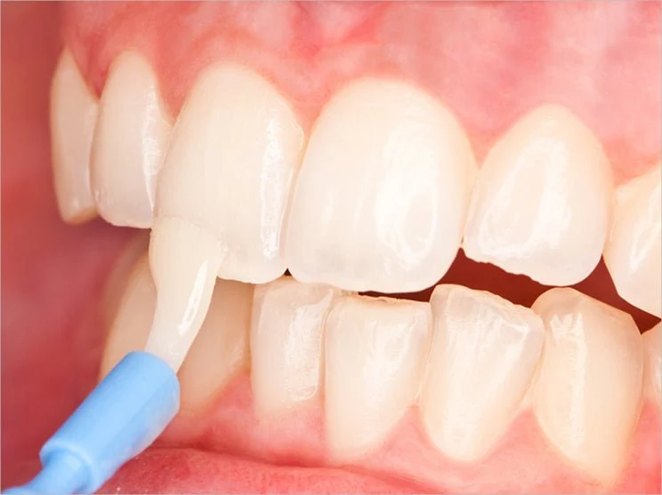 fluoride varnish