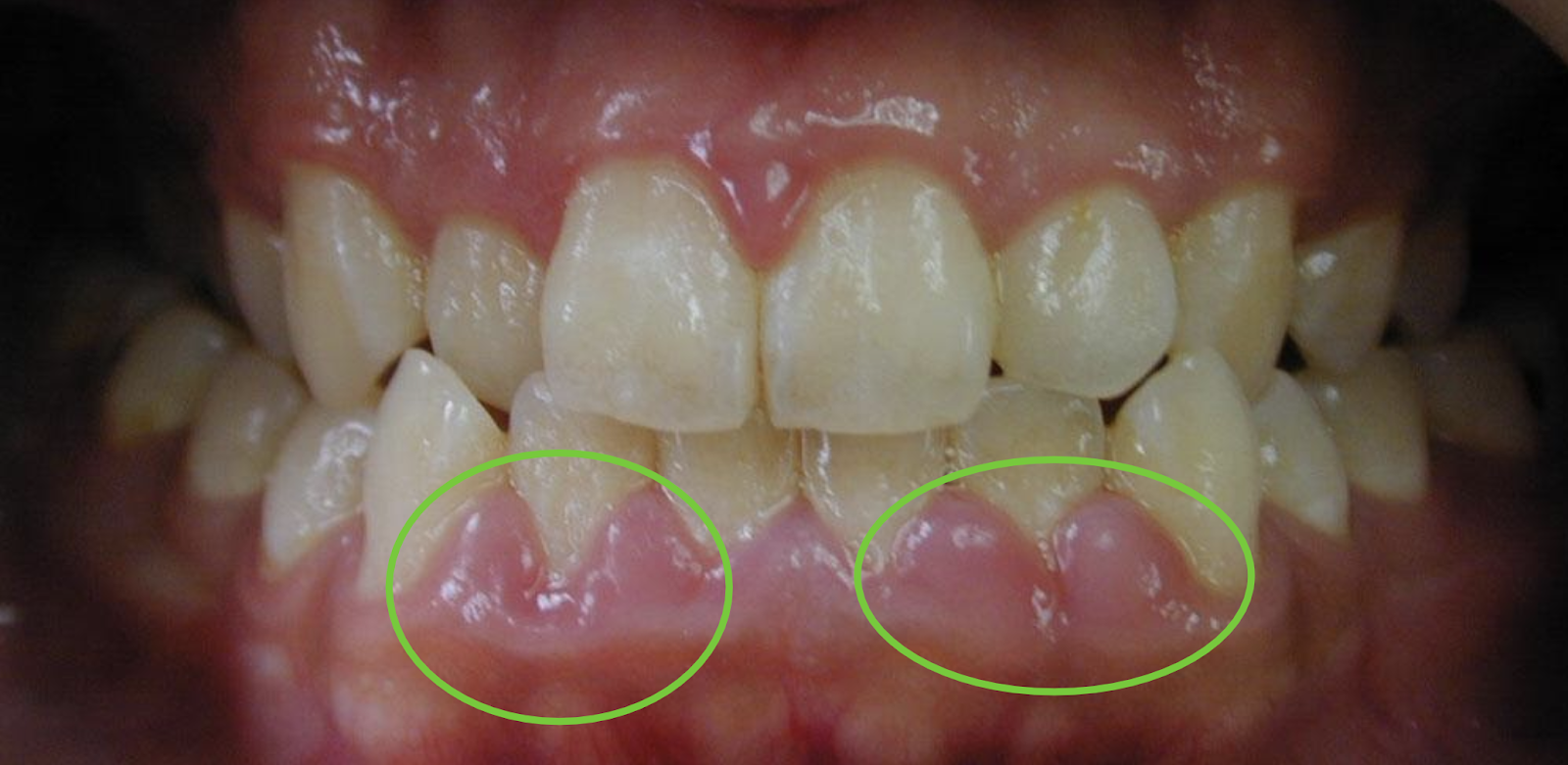 gingivitis gums 