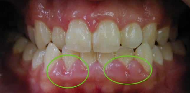 gingivitis gums 