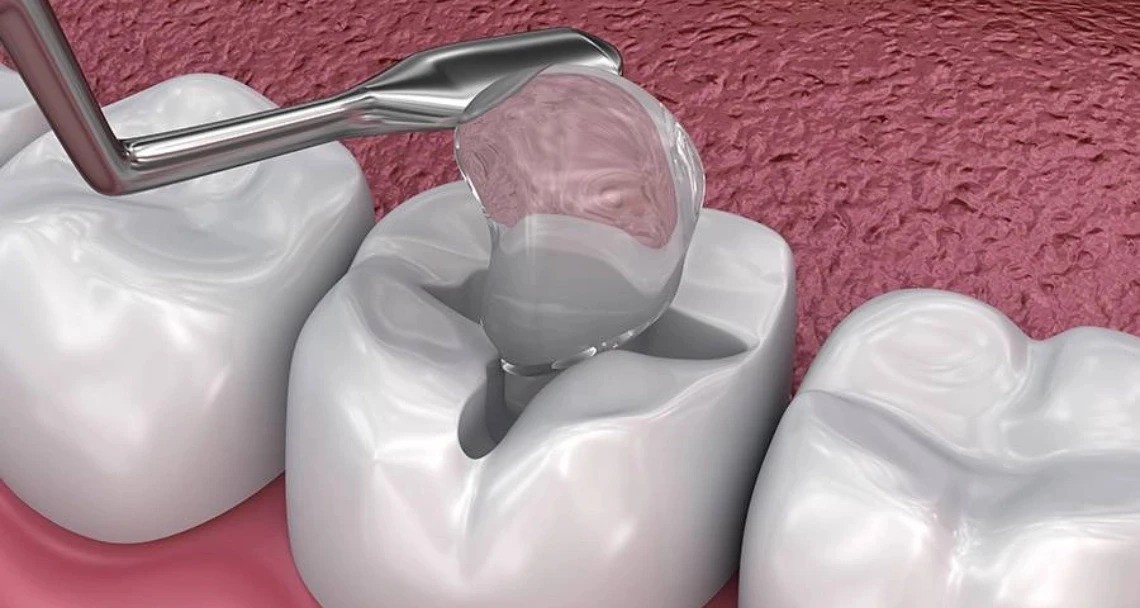 glass ionomer fillings